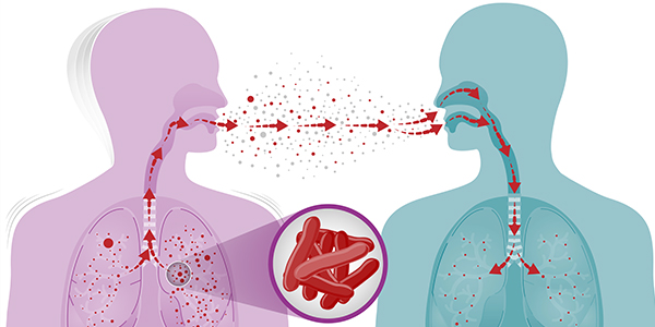 7 Gejala Klinis TBC pada Orang dengan HIV